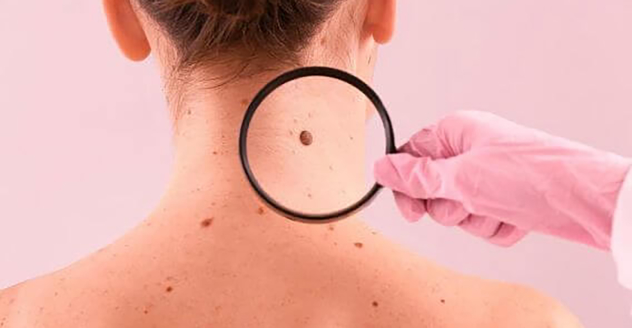 Mole Removal