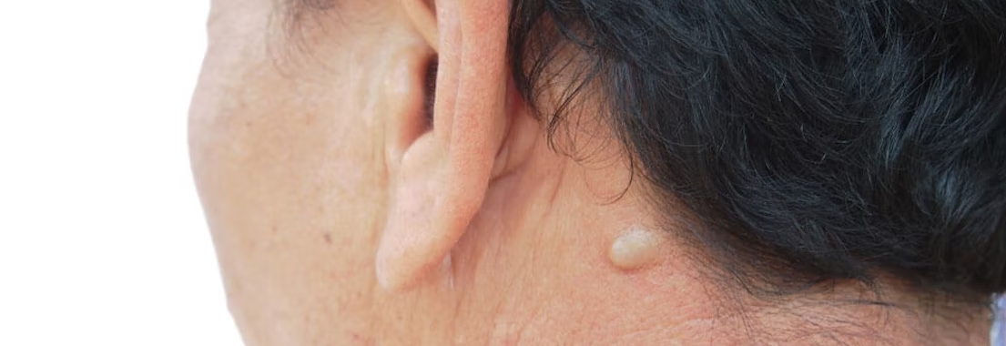 Sebaceous cyst removal