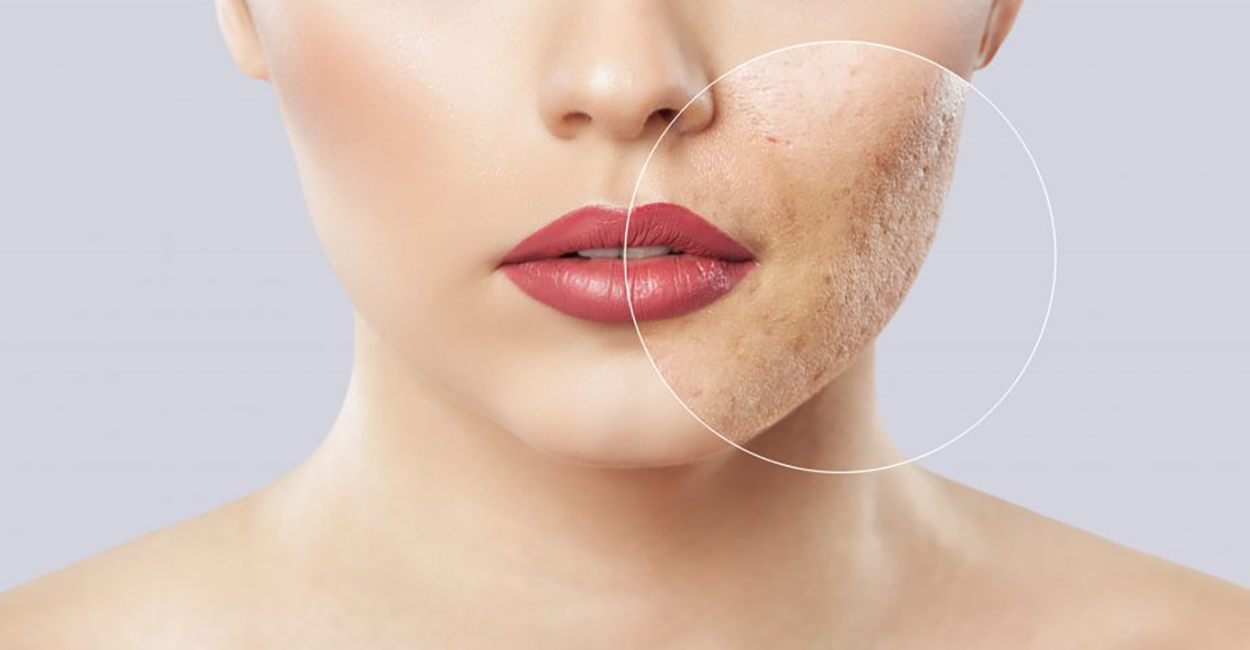 Acne & Scars