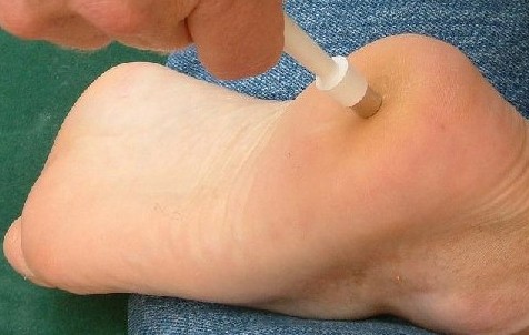 Skin Biopsy