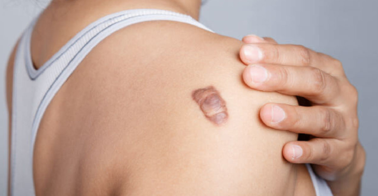 Keloid