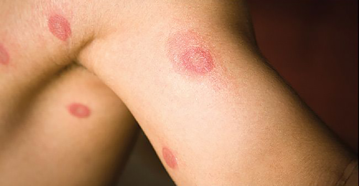 Bacterial Infection