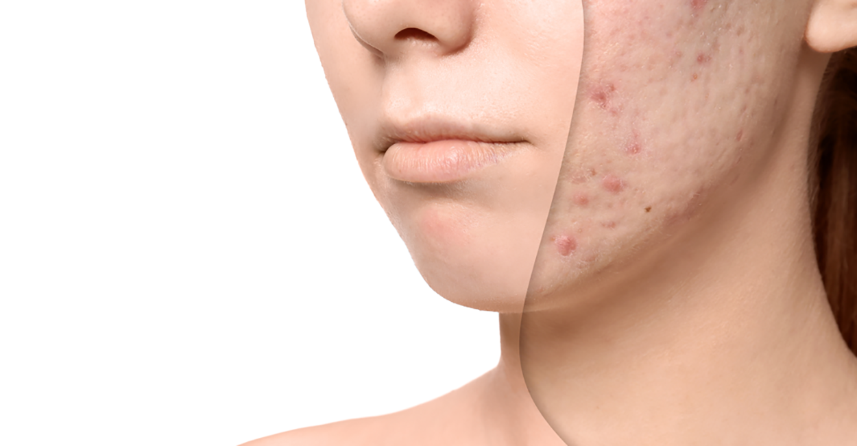 Acne and Scars