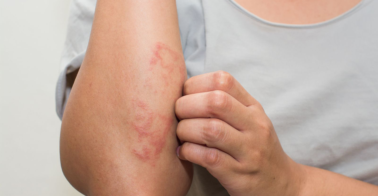 All kinds of Eczema & Atopic Dermatitis